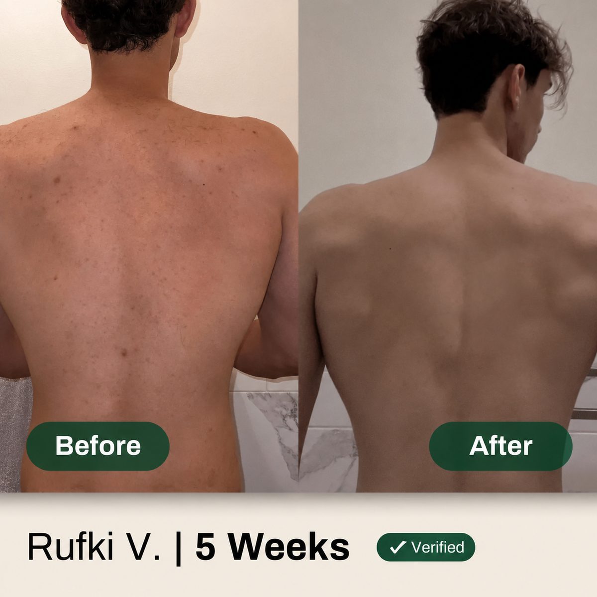 Before and after — back acne cleared in 5 weeks